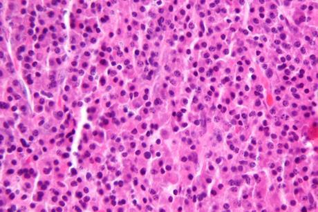 Plasmacytoma1