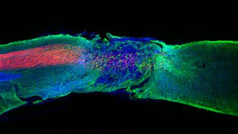 Regenerated axons in spinal cord lesion