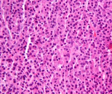 Plasmacytoma1