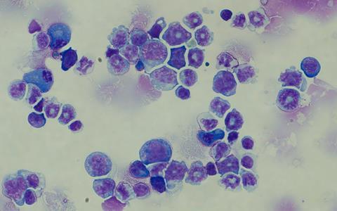 Leukaemia cells with the BIM variation